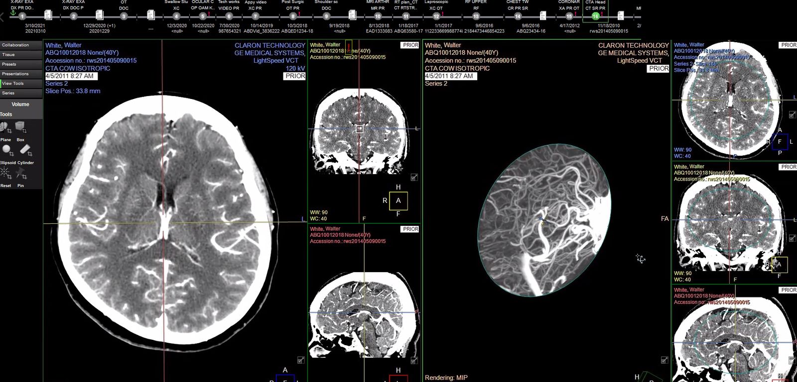 Multi-planar reconstruction & 3D angiography